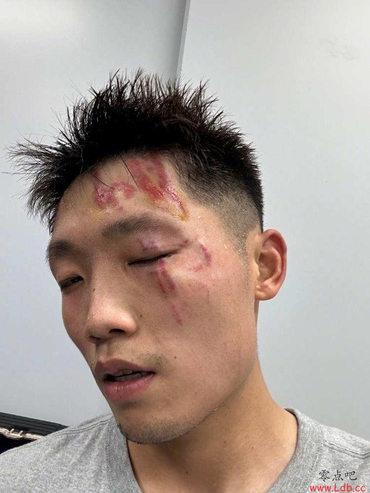 浙江队官博晒金浩翔受伤照,球员调侃自己又帅了一点